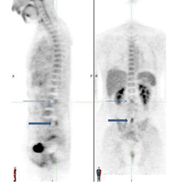 Corresponding sagittal and coronal PET images demonstrate that the lesions at L2-3 (thin arrows) and L5-S1 (thick arrows) are hypermetabolic.