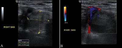 Figure 1. Ultrasonography of the neck (A) with Doppler analysis (B) demonstrates a 2.7 cm x 2.7 cm x 2.6 cm non-hypervascular mass just above the right clavicle at the midline, adjacent to the right subclavian vein.