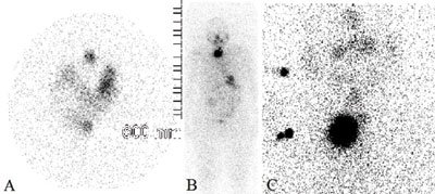 Figure 2. A preoperative anterior view of I-123 thyroid scintigraphy (A) demonstrates a large circumferential area of decreased tracer uptake in the midportion of the right thyroid lobe, which was proven benign on biopsy.