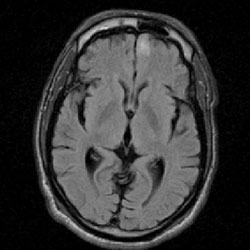 Figure 1. A diagnostic MRI shows an 8 mm x 6 mm frontal mass.