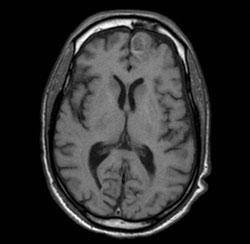 Figure 2. A follow-up MRI 10 days later shows the increase in size of the frontal mass with surrounding edema.