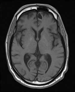 Figure 3. A follow-up MRI after three cycles of high-dose methotrexate shows the decrease in size and edema of the frontal mass.