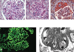 Figure 1: Renal biopsy. A light microscopy reveals thickened glomerular basement membranes (a). Glomerular capillaries focally display marginating leukocytes (b). One glomerulus shows a necrotizing crescent (c). Immunofluorescence microscopy reveals granular capillary wall stain for IgC (d). Electron microscopy shows subepithelial immune-type electron-dense deposits (e).