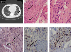 Figure 2: Lung mass. The spiculated mass found in the CT is seen in image a. The other images show histologic pictures taken from the biopsied mass: tumor cell nest (b); neoplastic epithelial cells showing abundant eosinophilic cytoplasm, nuclear pleomorphism, nuclear hyperchromasia and prominent nucleolar (c); PAS stain is positive for intra- and extracellular mucin (d); positive nuclear staining of TTF, consistent with primary adenocarcinoma of the lung (e); positive nuclear staining of p63, suggestive of squamous differentiation (f).