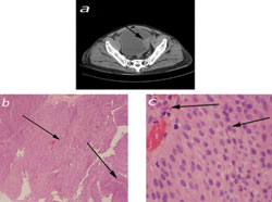 Figure 3. Image a shows the mass as found in the CT. Image b is the low-power field view of the biopsied mass, which shows abundant papillary growth of urothelium (arrows). Image c is the high-power field view that shows dysplastic urothelial cells showing small conspicuous nucleoli, nuclear pleomorphism and nuclear hyperchromasia (arrow on right). There are no dysplastic cell infiltrates into stroma of papillary fronts (arrow on left). Those feature low-grade, noninvasive papillary urothelial carcinoma.