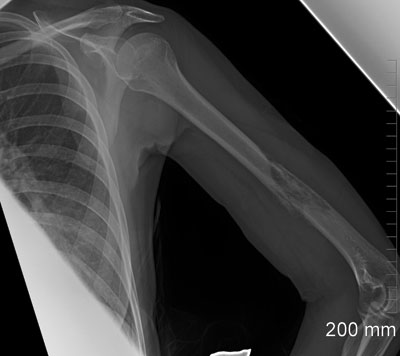 Figure 1. Frontal radiograph of the left humerus demonstrates irregular cortical destruction with permeative infiltration of the medullary cavity.