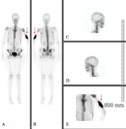 Figure 2. Technetium 99m MDP imaging of the anterior whole body (A) and posterior whole body (B), lateral high-resolution spot images of the neck (C and D), and a spot image of the left humerus (E) demonstrate a focus of markedly increased uptake in the region of the left humeral diaphysis (arrow).