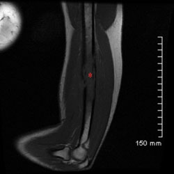 Figure 3. MRI of the left elbow utilizing sagittal noncontrast T1-weighted (A) and sagittal STIR (B) sequences demonstrate a 12-cm area of diffuse bone marrow signal abnormality consistent with edema (asterisk) involving the mid to distal humeral shaft with associated cortical erosion.