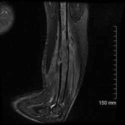 Figure 3. MRI of the left elbow utilizing sagittal noncontrast T1-weighted (A) and sagittal STIR (B) sequences demonstrate a 12-cm area of diffuse bone marrow signal abnormality consistent with edema (asterisk) involving the mid to distal humeral shaft with associated cortical erosion.