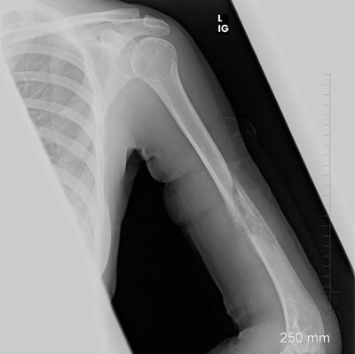 Figure 4. Follow-up frontal radiograph of the left humerus demonstrates increased callus tissue around the osteolytic lesion in the left mid humerus with increased sclerosis within the marrow cavity. No new lesion is identified.