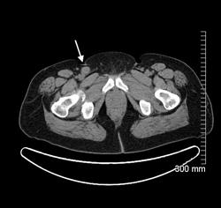 Figure 2c. The previously seen hypermetabolic right inguinal lymph node has increased in size and associated metabolic activity, now measuring 2.1 cm in size with a maximum SUV of 5.7.