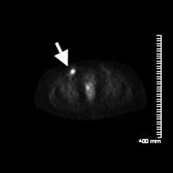 Figure 2c. The previously seen hypermetabolic right inguinal lymph node has increased in size and associated metabolic activity, now measuring 2.1 cm in size with a maximum SUV of 5.7.