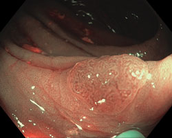 Many gastroenterologists consider real-time optical diagnosis with advanced imaging a sensible alternative to routine postpolypectomy pathological analysis of diminutive colorectal polyps, primarily due to reduced costs and improved efficiency.