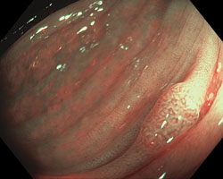 Many gastroenterologists consider real-time optical diagnosis with advanced imaging a sensible alternative to routine postpolypectomy pathological analysis of diminutive colorectal polyps, primarily due to reduced costs and improved efficiency.