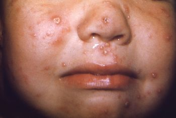 Varicella lesions on the face of a young child.