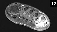 Figure 12: osteochondritis due to a nail puncture