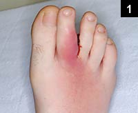 Figure 1: painful, swollen right foot