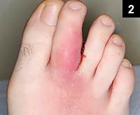 Figure 2: painful, swollen right foot