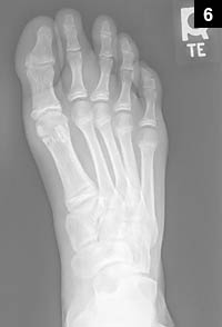 Figure 6: Plain radiograph of the foot