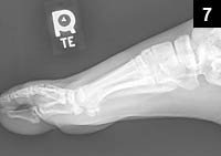 Figure 7: Plain radiograph of the foot