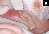 Figure 8: soft tissue infections with drainage alone