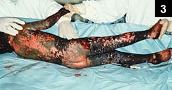 Figure 3: Large proportion of her skin surface was dark with what appeared to be an eschar