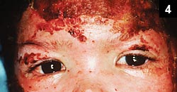 Figure 4: Her eyes were inflamed with no appreciable discharge