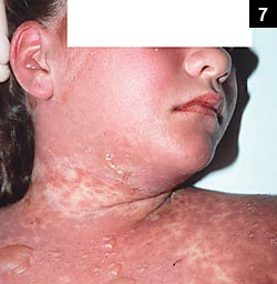 Figure 7: Patients with Toxic Epidermal Necrolysis (TEN) are more likely to have intact blisters