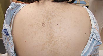 Brown papules in a net-like pattern on upper back, as well as in the inframammary area