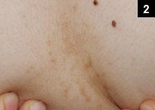 Figure 2: Centrally, the papules coalesce but remain reticulated at the periphery