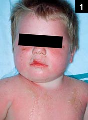 Figure 1: A 21-month-old boy was admitted from the clinic with a febrile illness and a rash