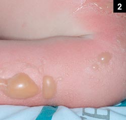 Figure 2: A painful rash with diffuse erythema and blister formation