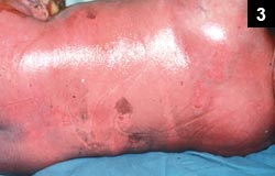 Figure 3: Patients with staphylococcal scalded skin syndrome will be red all over