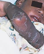 Rash and peeling due to Kawasaki disease