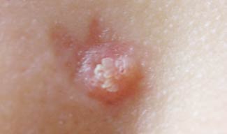 Epidermal nevi are cutaneous hamartomas that are usually present from birth