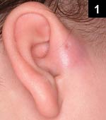 Figure 1: Painful swelling and erythema of the right ear