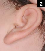 Figure 2: Examination revealed a preauricular pit of the left ear