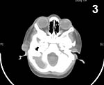 Figure 3: Computed tomography scan image