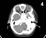 Figure 4: Computed tomography scan image