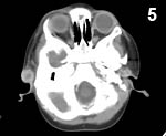 Figure 5: Computed tomography scan image