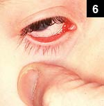 Figure 6: Conjunctivitis with ipsilateral preauricular lymphadenitis can be caused by tularemia or cat scratch disease