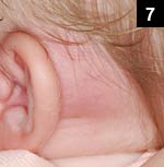 Figure 7: Mastoiditis also causes painful swelling, but it would be postauricular