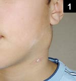 Figure 1: Enlarged left anterior cervical lymph node measuring approximately 4 cm in diameter