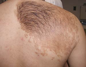 A well-demarcated brown patch with very dark hair overlying it and smaller tan macules surrounding it