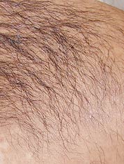 The overlying hair may be removed with depilatories or with laser