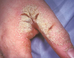 A thickened crusted area of the hands that had been present for two months