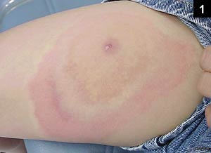 Figure 1: A ring of erythema surrounding lesion on right leg