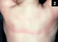 Figure 2: The characteristic ring-shaped rash may be small or so large that it may be hard to recognize