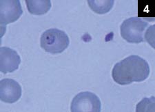 Figure 4: Diagnosis is made by showing the typical intraerythrocytic tetrad-appearing protozoa on a blood smear