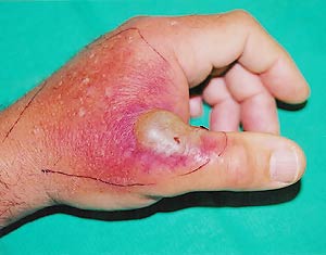 An abscess over the metacarpophalangeal joint of the thumb